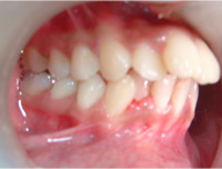 Correction of forward teeth