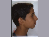 Correction of retruded jaw with crowding
