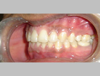 Afetr Clear aligner retainer Treatment