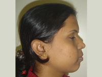 Condition of Face Before the Correction of Forward Teeth