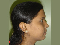 Picture of Patient After Correction of Forward Teeth Treatment