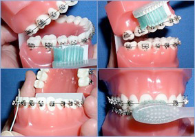 Brushing n cleaning instructions for braces and teeth cleaning